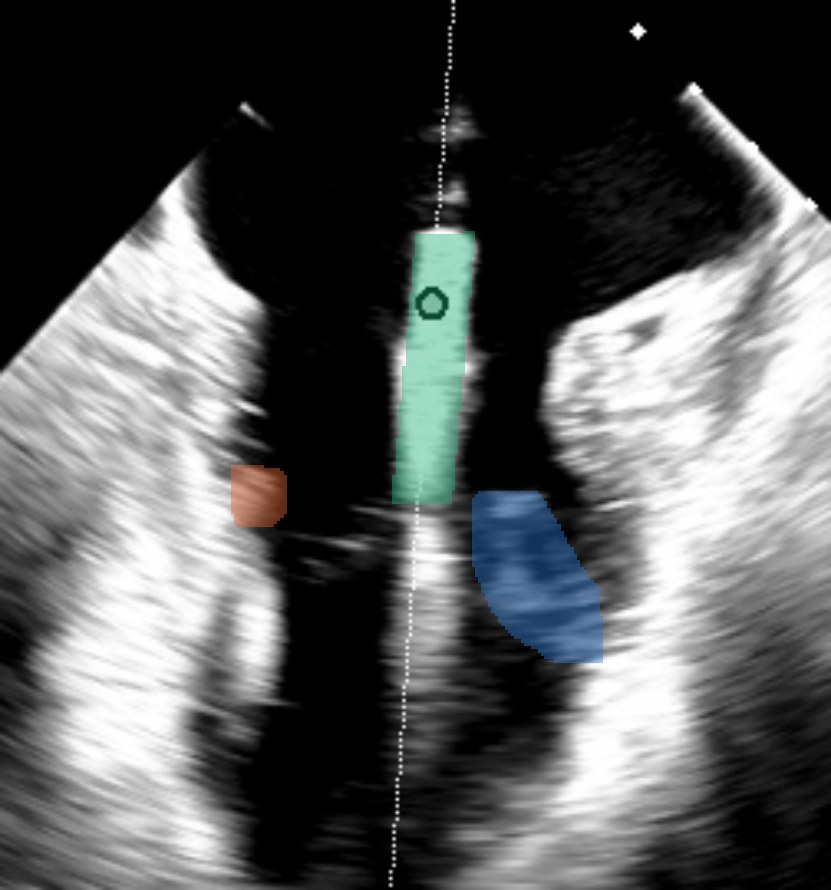TEE frame with AutoClip overlay: clip, medial and lateral papillary muscles segmented; clip position on the papillary-muscle axis reads t = 0.54